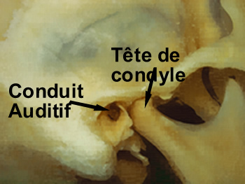 articulation mandibule crâne A T M, avec acouphènes